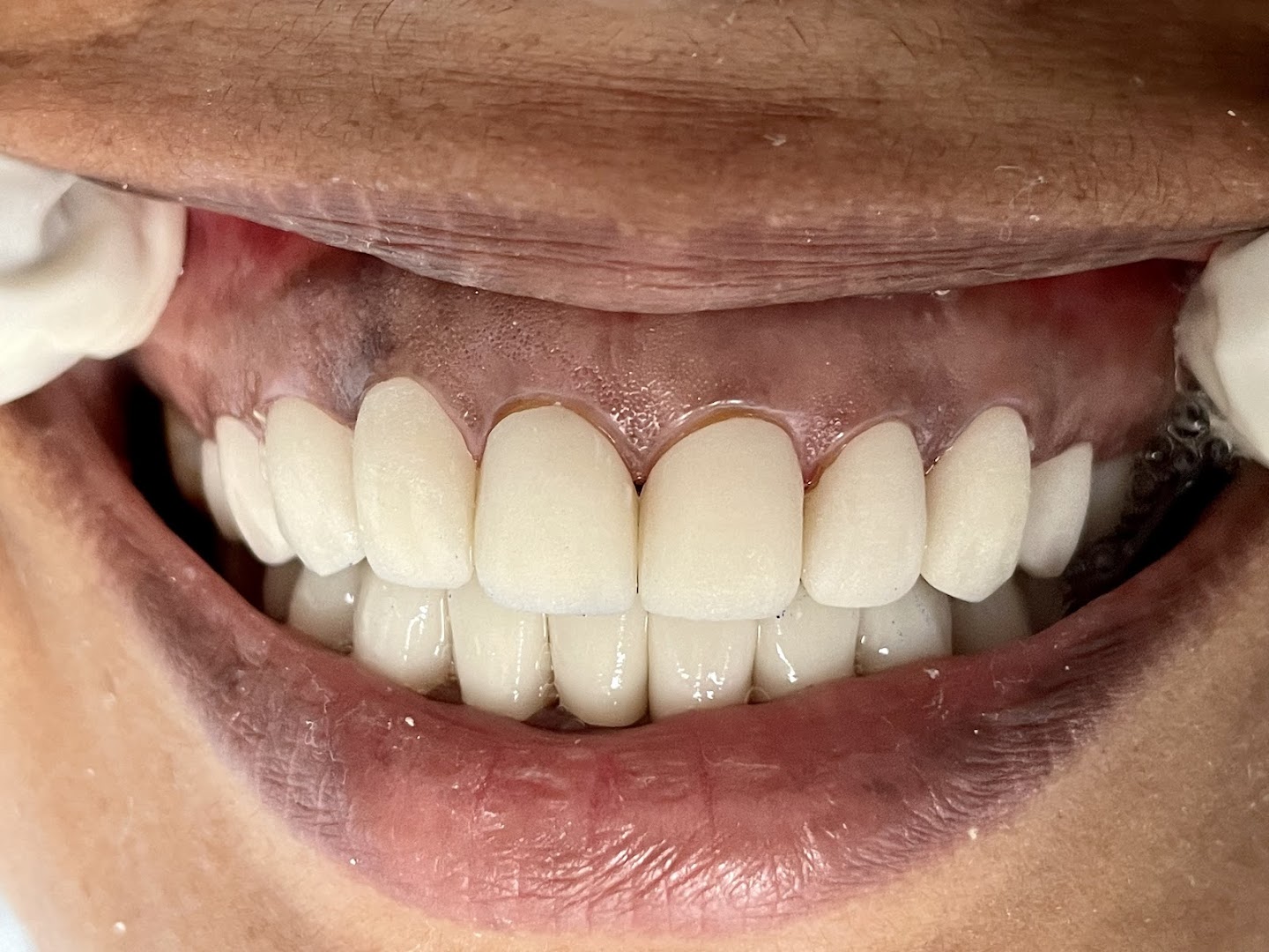 Completed dental veneer work at Dental Chambers — gloved hands shown with full set of natural-looking veneers
