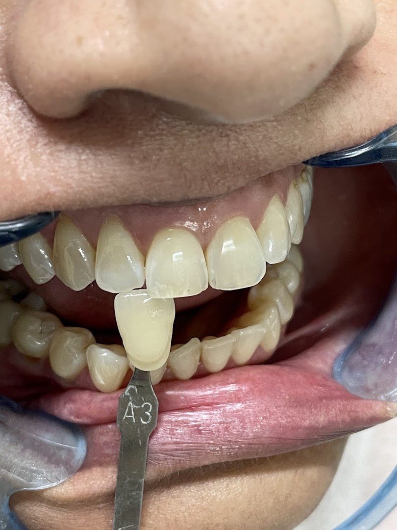 Clinical shade-guide A3 being used for colour-matching in a Dental Chambers restoration procedure