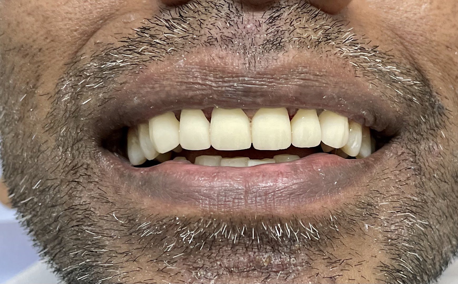 Close-up of completed dental crown restoration at Dental Chambers showing natural tooth alignment